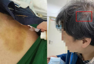 男子因停车冲突被打骨折 打人者送来5万元私了被拒