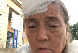 一次医疗事故 女子脑脊液外渗！24小时从眼鼻渗出 持续18年…