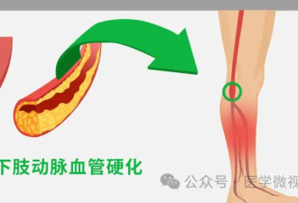 出现这些症状可能是“腿梗” 这四类人群要警惕