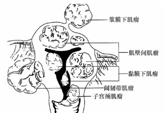 警惕！子宫肌瘤竟会变性？早看早知道