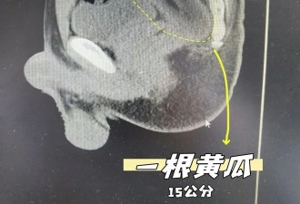江苏男塞黄瓜入肛门“治便秘” 网民都笑而不语