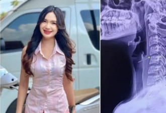 按摩把自己干进了ICU！这几类人小心