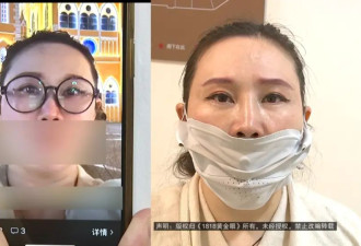 做鼻子填充后歪了？女子晒术前对比照，美容公司：钱退一部分，但报道不能播