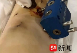 女子花60万去国外“断骨增高”13厘米,后遗症缠身