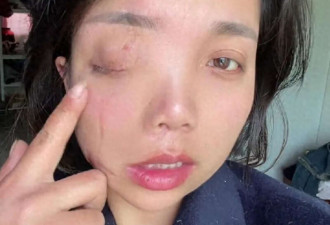 女子左眼失明 办残证被拒 残联:双眼残才算