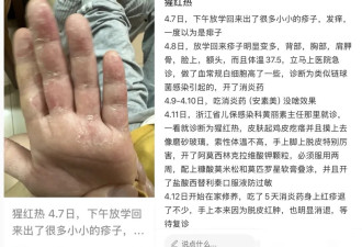 广东确诊1542例，疾控紧急提醒：进入高发期，无疫苗可预防