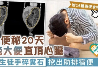 大便攻心!她17天没排便 宿便堆积直戳心脏