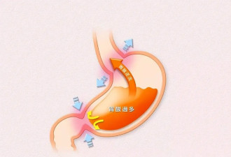 出现这些症状 小心胃食管反流