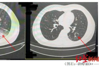男子吹空调致“白肺”，专家提醒警惕军团菌肺炎