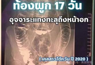 台湾女便秘竟憋到“吐翔” X光显示塞满胸腔