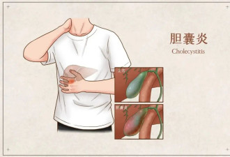 不规律吃饭 当心胆囊炎