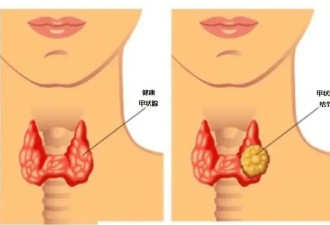 查出甲状腺结节 还能食用碘盐吗？