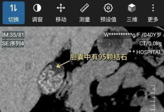 这个习惯很危险 中国女子体内查出95颗结石