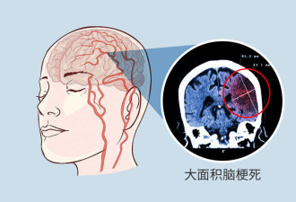 为何中国脑梗死患者越来越多？3种调料是元凶
