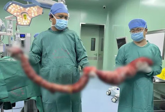 4个月没如厕 他腹中盘据10kg巨蟒结肠 体重30kg