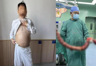 男子4个月未排便！肿如孕妇 医生终取出2米长20斤“巨蟒”
