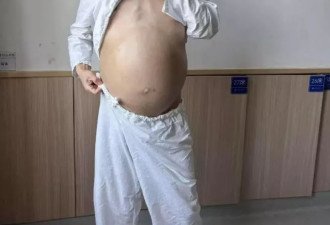 男子4个月未排便！肿如孕妇 医生终取出2米长20斤“巨蟒”