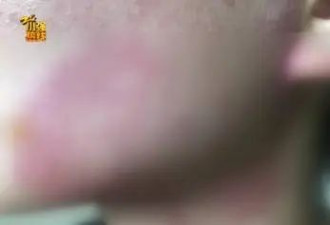 “想变得美美的”，结果惨不忍睹！杭州一姑娘要哭了：竟然感染了…