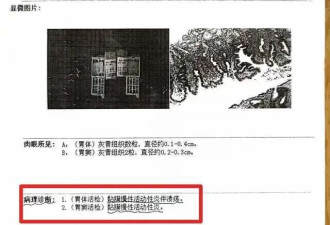 79岁老先生患慢性胃炎，被按胃癌晚期切除全胃