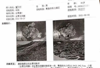 79岁老先生患慢性胃炎，被按胃癌晚期切除全胃