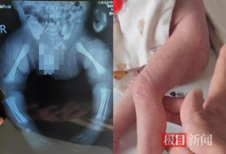 残疾夫妇二胎查出先天性病症，称医院产检漏检