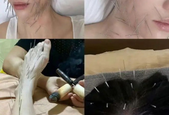 陈乔恩对自己太狠了！为变美全身扎满长针，网友看后直呼好恐怖！
