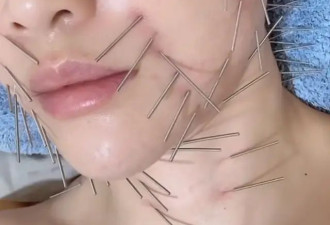 陈乔恩对自己太狠了！为变美全身扎满长针，网友看后直呼好恐怖！