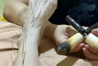 陈乔恩脸上头上脚上数百根针，触目惊心好吓人