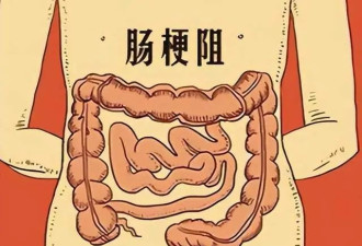 肠梗阻拖延1小时 肠坏死风险增加30%