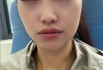 女子吃杨梅过敏眼睛肿成特效，医生：这非常罕见