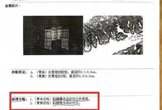 恐怖：中国老人检查出胃炎却被当癌症切除全胃