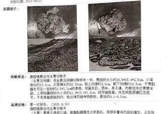 恐怖：中国老人检查出胃炎却被当癌症切除全胃