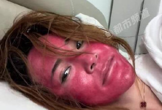 不卸妆22年？中国女变“关公” 脸部红肿硬如壳