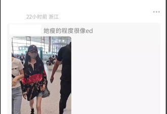 宋祖儿脸部浮肿四肢瘦，疑似进食障碍长期催吐