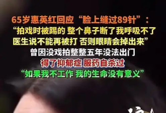 65岁惠英红回应“脸上缝过89针”！曾因拍戏整个鼻子断掉
