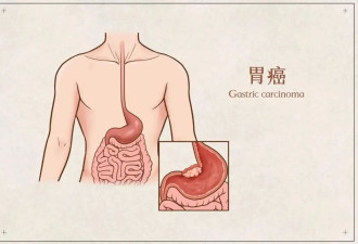 胃癌“偏爱”哪些人？预防胃癌 做好3件事