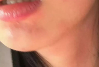 女演员王楚然求治荨麻疹，网友大呼感同身受：太折磨人