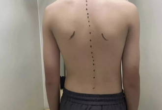 500万青少年中招，这病已成第三大健康威胁