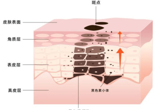 斑点淡化的有效方法 重拾无瑕美肌