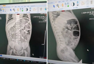 “你孩子没有肛门”，怕孩子被说闲话 甚至不敢送幼儿园