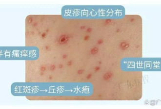 1岁多男孩遭女子强搂亲吻当晚高烧,妈妈怒回:确诊是水痘