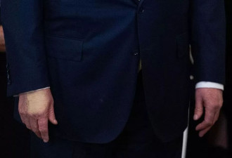 小腿出现肿胀，特朗普患上的静脉疾病是什么