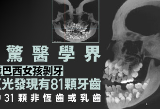 女童想拔牙照X光惊见81颗牙 31颗非恒齿或乳齿