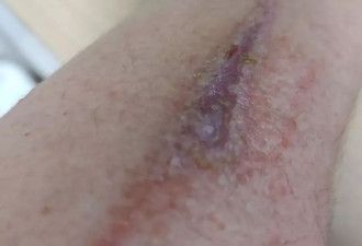 随着夏天到来，中国的毒虫正扩散至北方...