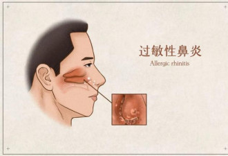 过敏性鼻炎让肺癌风险降低两成？