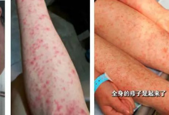 无特效药！广东一地发布基孔肯雅热后遗症告知书