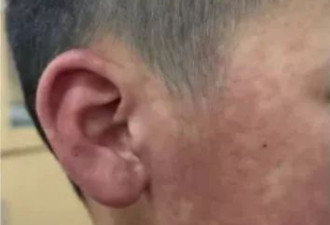 基孔肯雅热多张患者照片曝光：全身严重出疹…