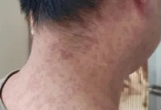 基孔肯雅热多张患者照片曝光：全身严重出疹…