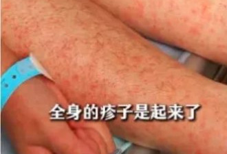 基孔肯雅热多张患者照片曝光：全身严重出疹…