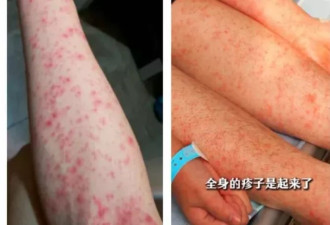 基孔肯雅热多张患者照片曝光：全身严重出疹…